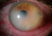 ceratocone hidropsia.JPG